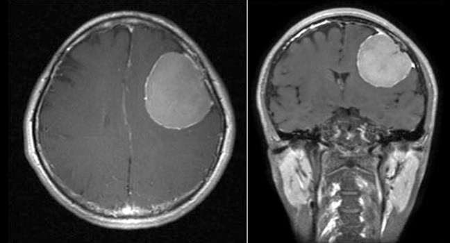 髄膜腫MRI画像