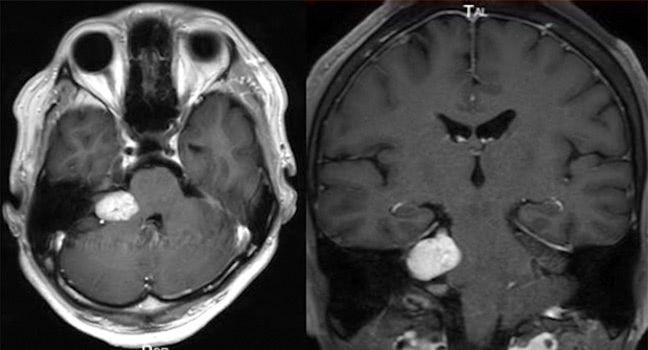 聴神経鞘腫MRI画像